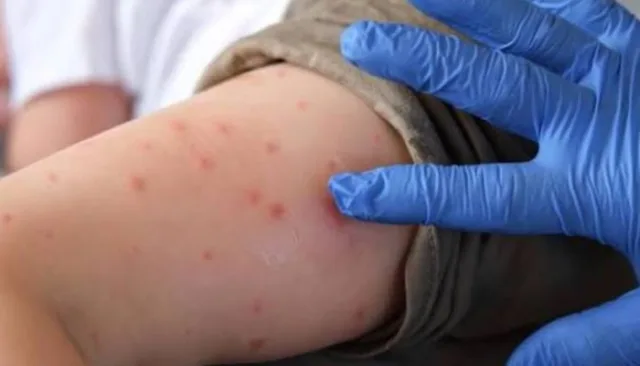 Pennsylvania reports fourth measles death in worst state outbreak in 35 …